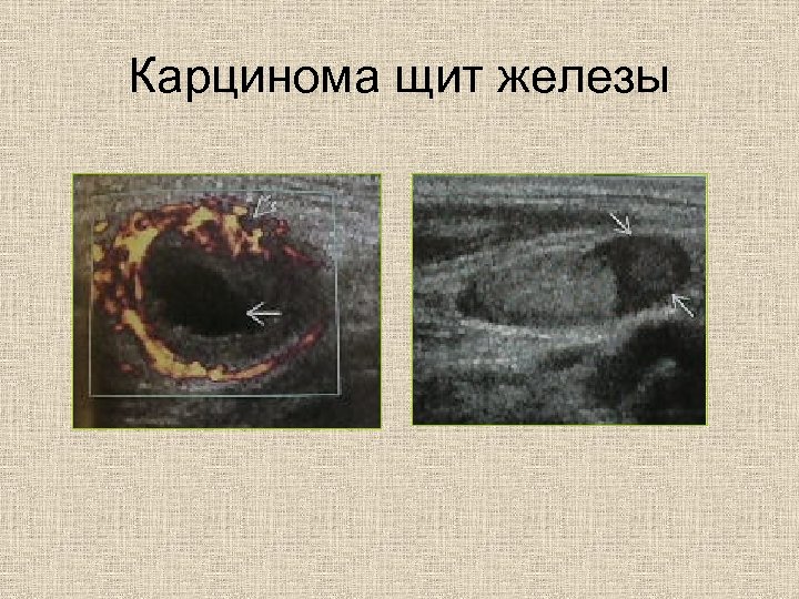 Карцинома щит железы 