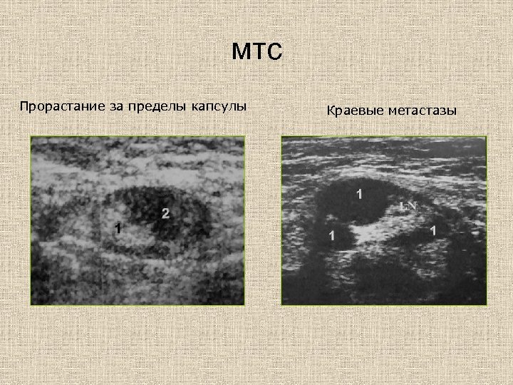 мтс Прорастание за пределы капсулы Краевые метастазы 