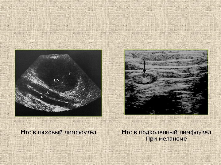 Мтс в паховый лимфоузел Мтс в подколенный лимфоузел При меланоме 