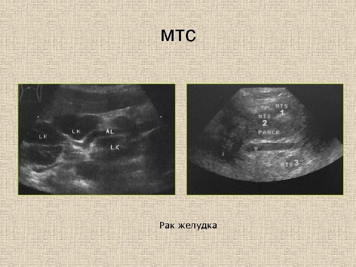 мтс Рак желудка 