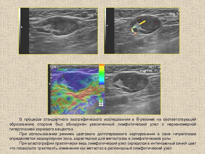 В процессе стандартного эхографического исследования в В-режиме на соответствующей образованию стороне был обнаружен увеличенный