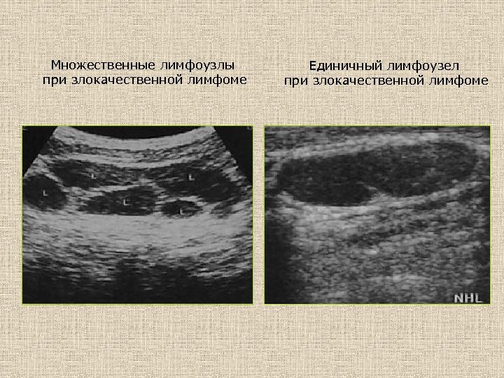 Множественные лимфоузлы при злокачественной лимфоме Единичный лимфоузел при злокачественной лимфоме 