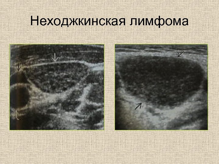 Неходжкинская лимфома 