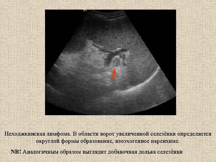 Неходжкинская лимфома. В области ворот увеличенной селезёнки определяется округлой формы образование, изоэхогенное паренхиме. NB!
