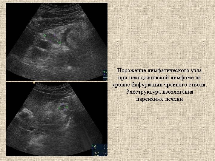Поражение лимфатического узла при неходжкинской лимфоме на уровне бифуркации чревного ствола. Эхоструктура изоэхогенна паренхиме