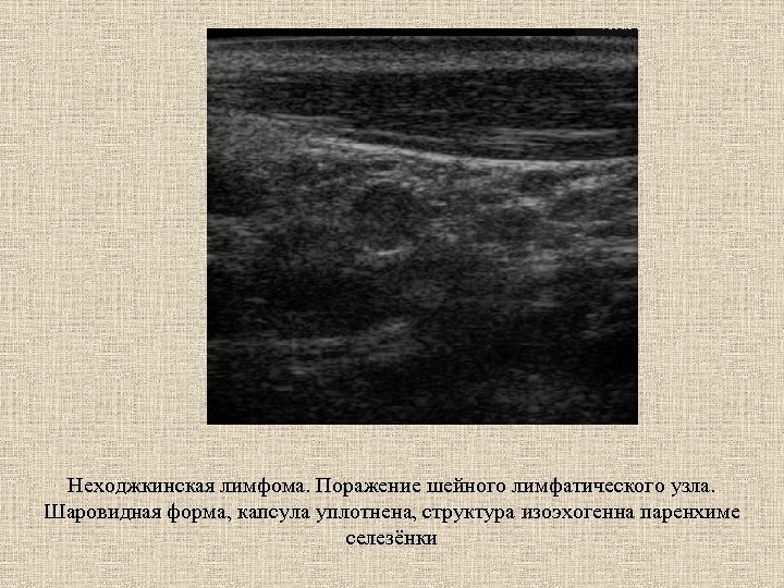 Неходжкинская лимфома. Поражение шейного лимфатического узла. Шаровидная форма, капсула уплотнена, структура изоэхогенна паренхиме селезёнки