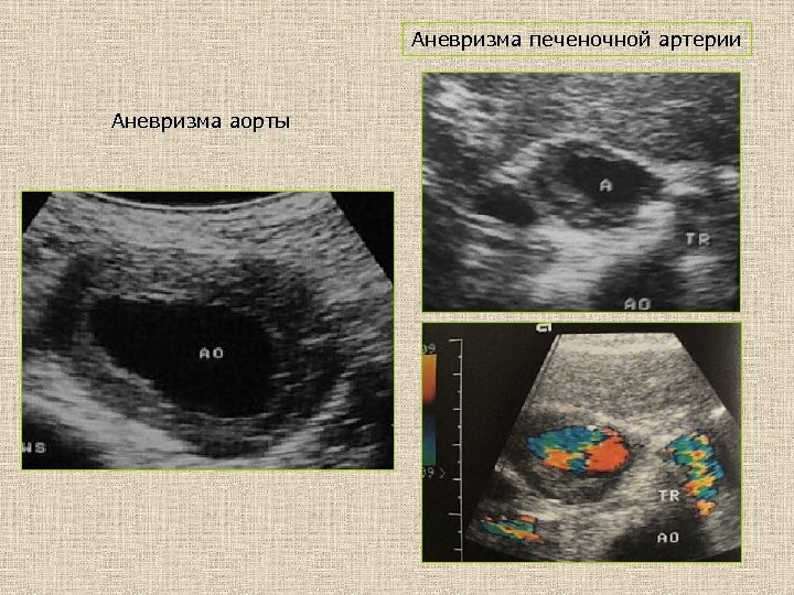 Аневризма печеночной артерии Аневризма аорты 