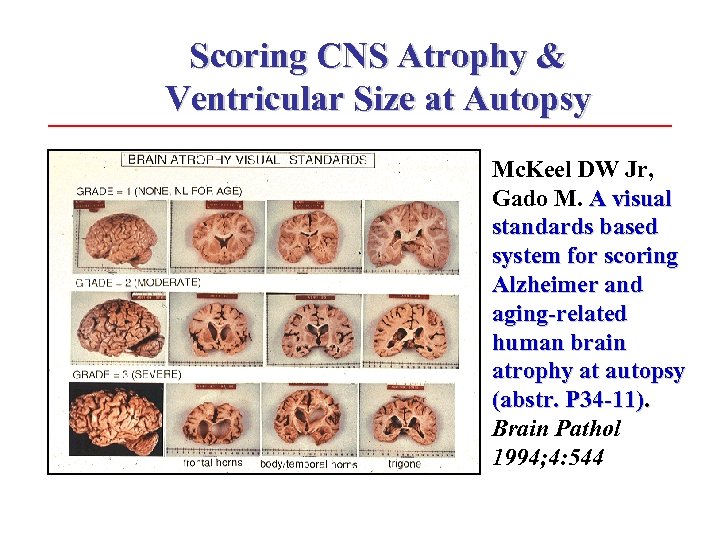 Scoring CNS Atrophy & Ventricular Size at Autopsy Mc. Keel DW Jr, Gado M.