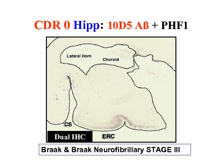 CDR 0 Hipp: 10 D 5 Aß + PHF 1 Dual IHC Braak &