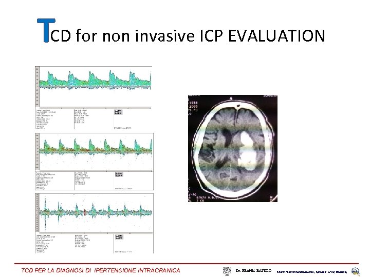 TCD for non invasive ICP EVALUATION TCD PER LA DIAGNOSI DI IPERTENSIONE INTRACRANICA Dr.