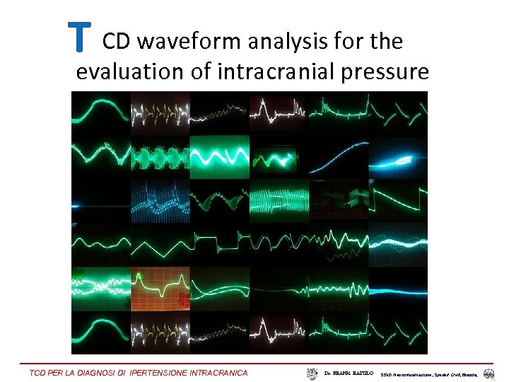 T CD waveform analysis for the evaluation of intracranial pressure TCD PER LA DIAGNOSI