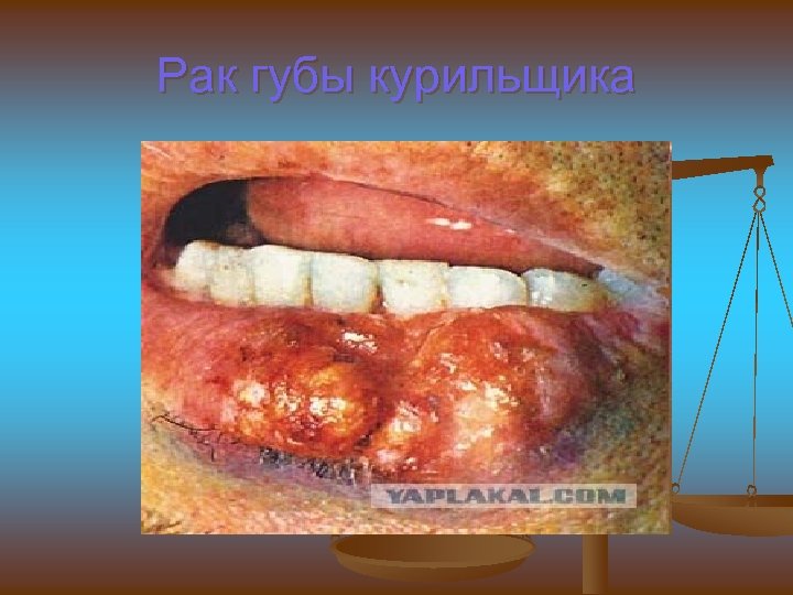 Рак губы курильщика 