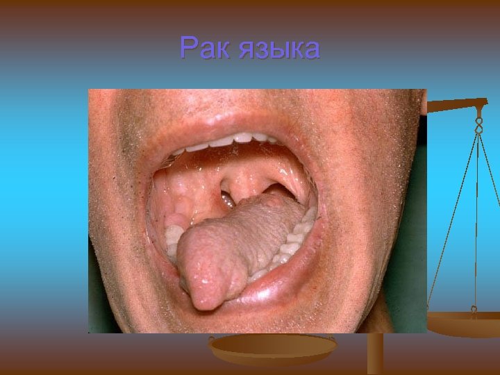 Рак языка 