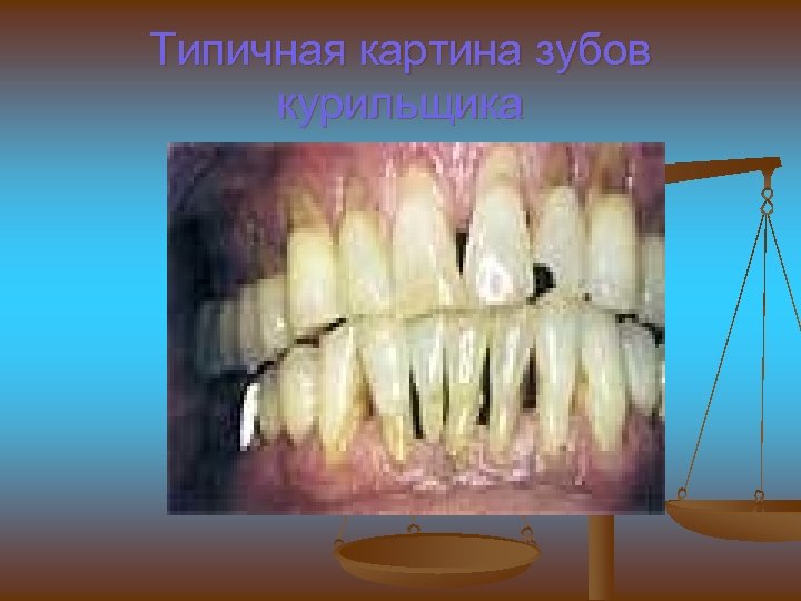 Типичная картина зубов курильщика 