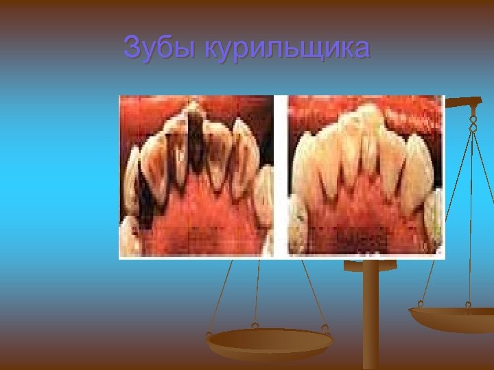 Зубы курильщика 