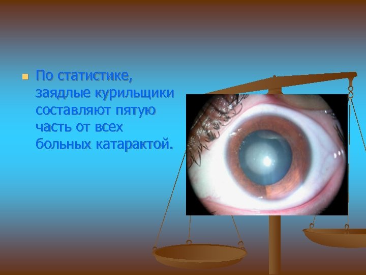 n По статистике, заядлые курильщики составляют пятую часть от всех больных катарактой. 