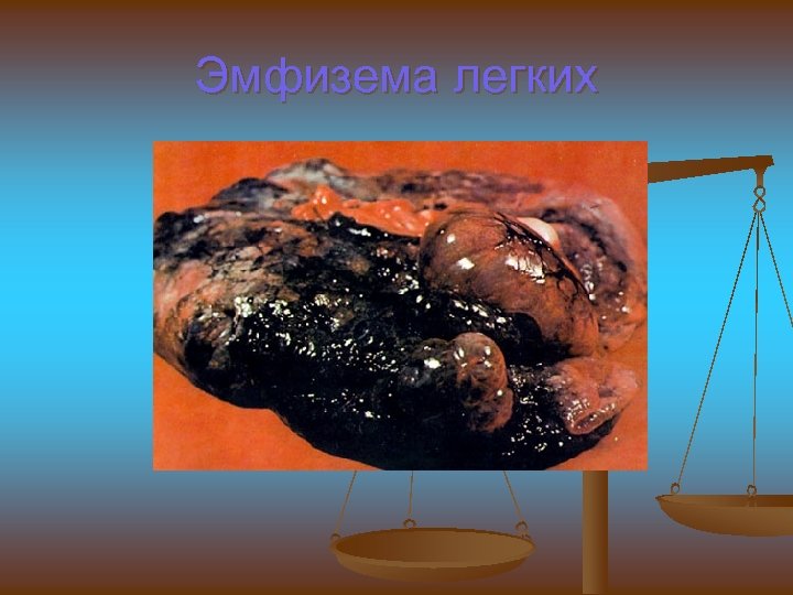 Эмфизема легких 