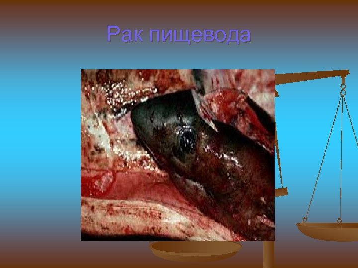 Рак пищевода 