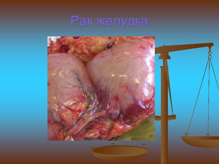 Рак желудка 