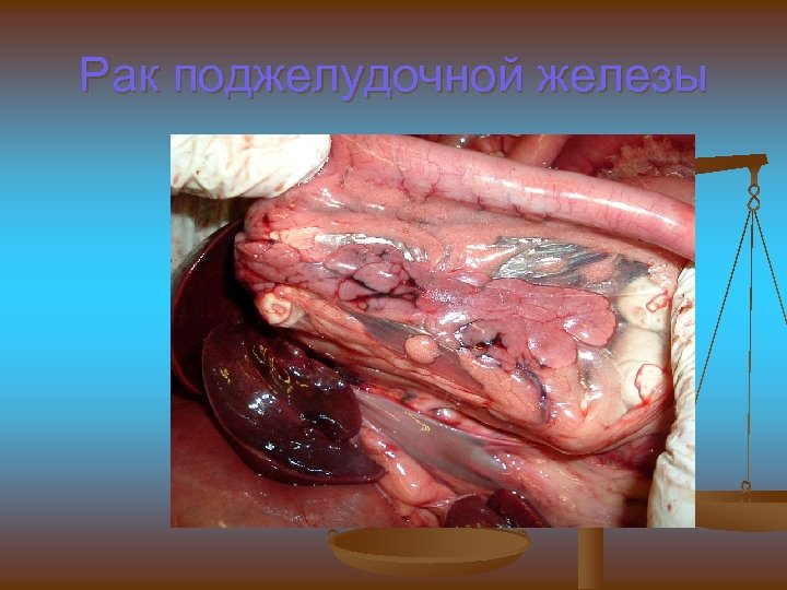 Рак поджелудочной железы 