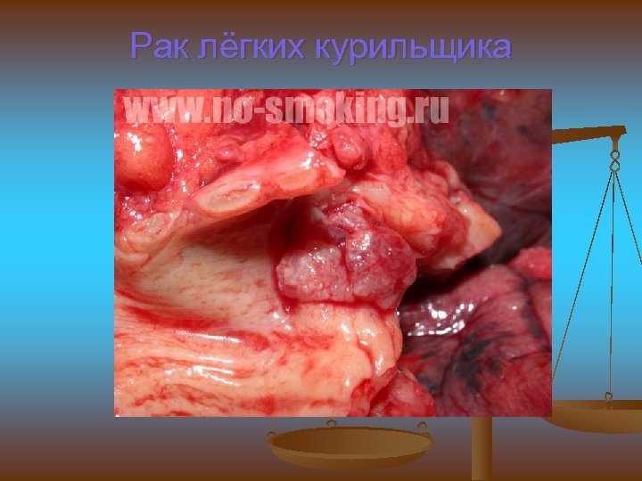 Рак лёгких курильщика 