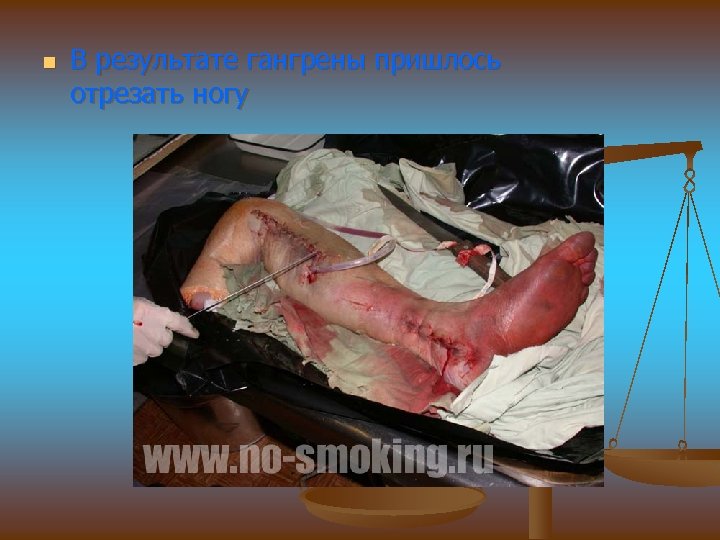 n В результате гангрены пришлось отрезать ногу 