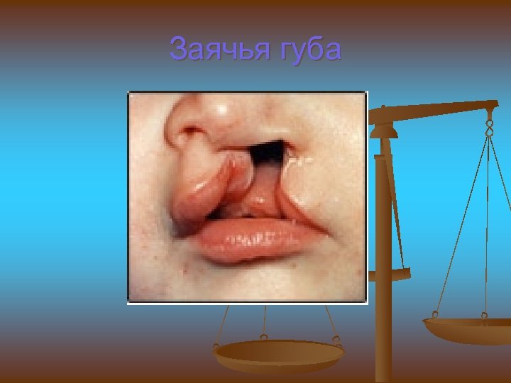 Заячья губа 