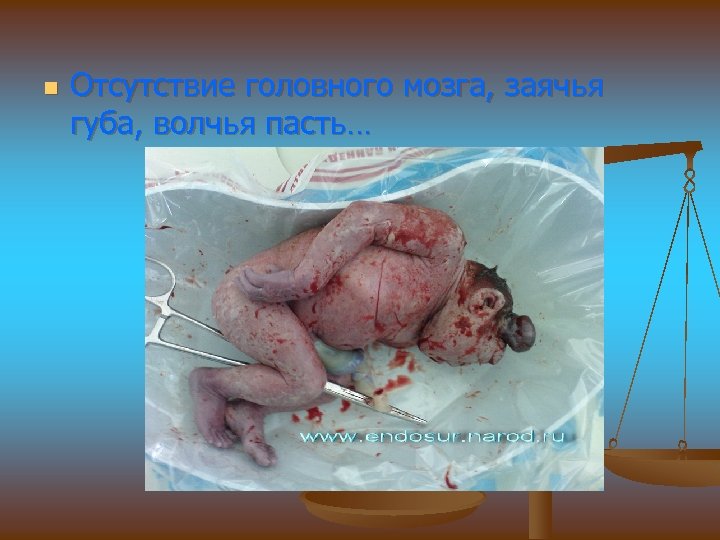 n Отсутствие головного мозга, заячья губа, волчья пасть… 