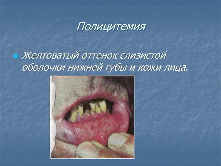 Полицитемия n Желтоватый оттенок слизистой оболочки нижней губы и кожи лица. 