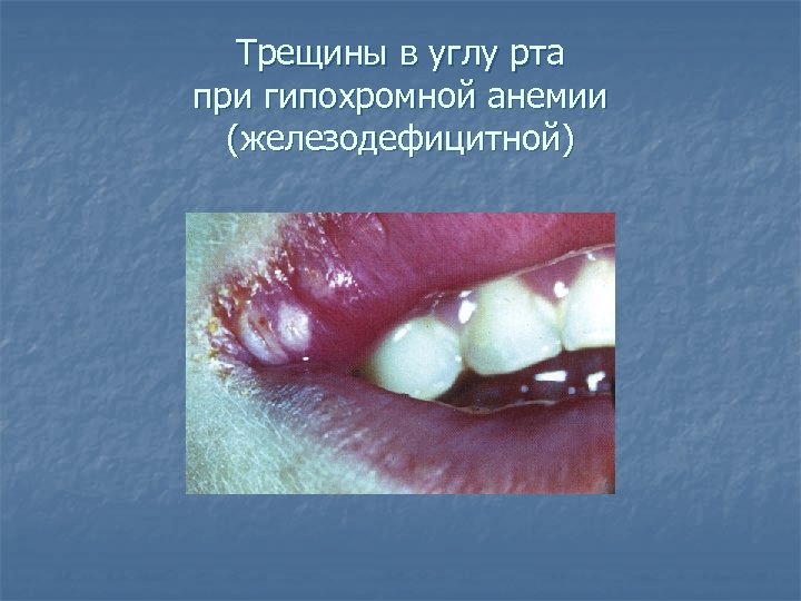 Трещины в углу рта при гипохромной анемии (железодефицитной) 