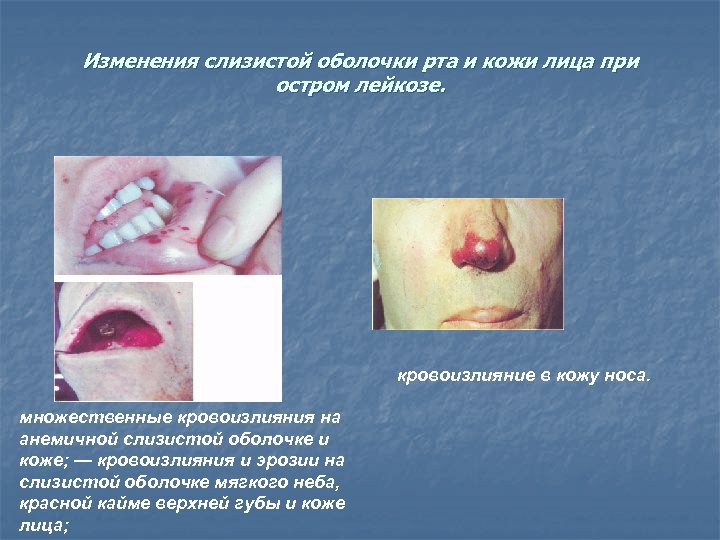 Изменения слизистой оболочки рта и кожи лица при остром лейкозе. кровоизлияние в кожу носа.