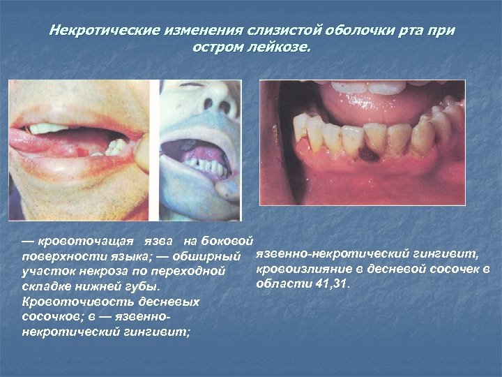 Некротические изменения слизистой оболочки рта при остром лейкозе. — кровоточащая язва на боковой поверхности