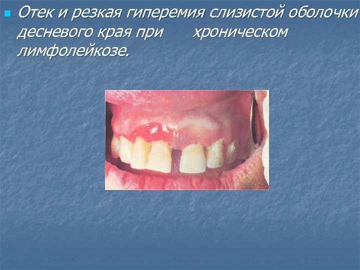n Отек и резкая гиперемия слизистой оболочки десневого края при хроническом лимфолейкозе. 