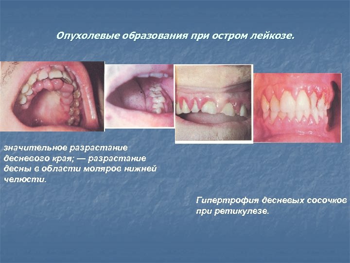 Опухолевые образования при остром лейкозе. значительное разрастание десневого края; — разрастание десны в области