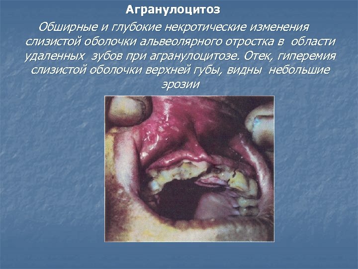 Агранулоцитоз Обширные и глубокие некротические изменения слизистой оболочки альвеолярного отростка в области удаленных зубов