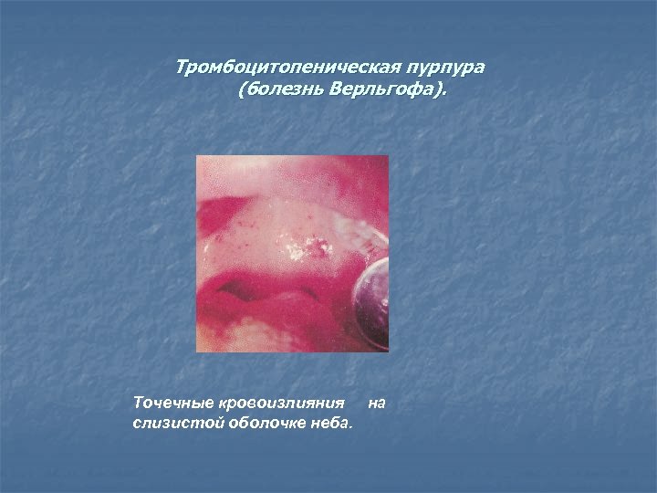 Тромбоцитопеническая пурпура (болезнь Верльгофа). Точечные кровоизлияния на слизистой оболочке неба. 