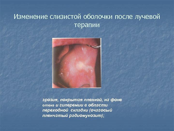 Изменение слизистой оболочки после лучевой терапии эрозия, покрытая пленкой, на фоне отека и гиперемии