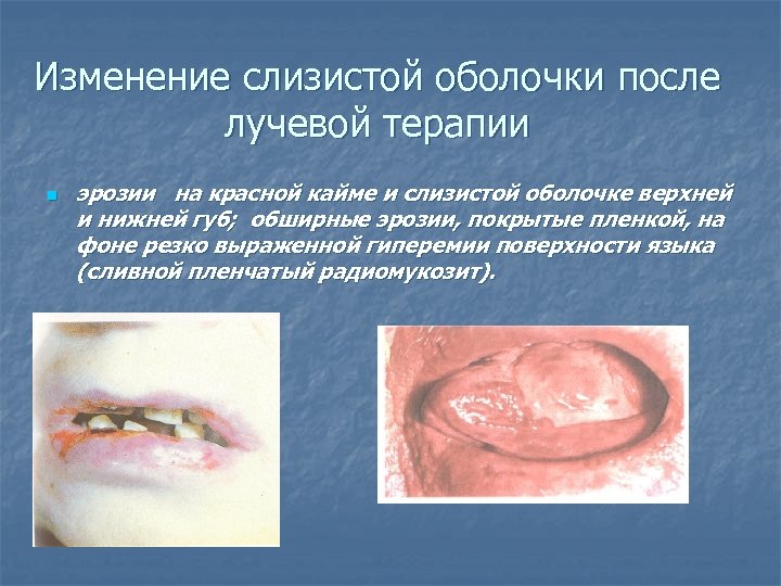 Изменение слизистой оболочки после лучевой терапии n эрозии на красной кайме и слизистой оболочке