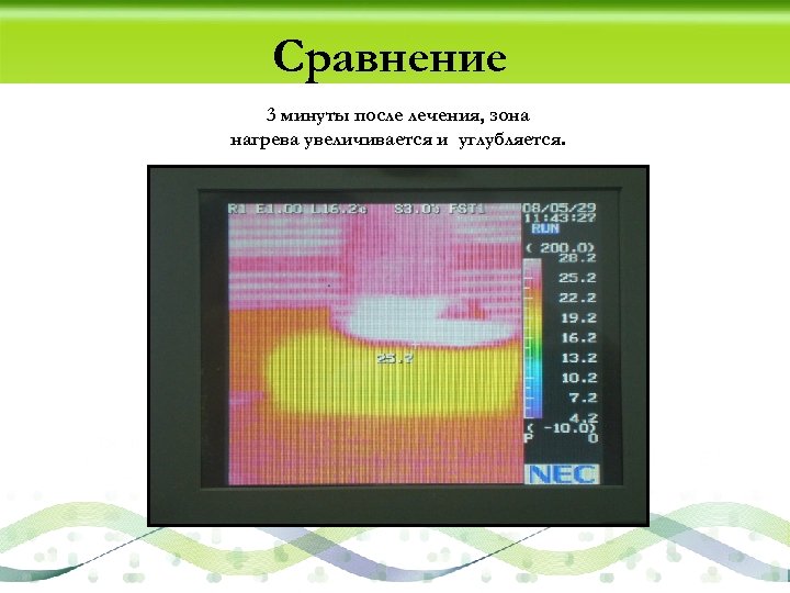 Сравнение 3 минуты после лечения, зона нагрева увеличивается и углубляется. 