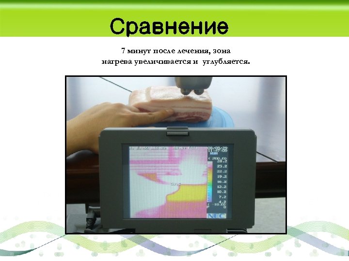 Сравнение 7 минут после лечения, зона нагрева увеличивается и углубляется. 