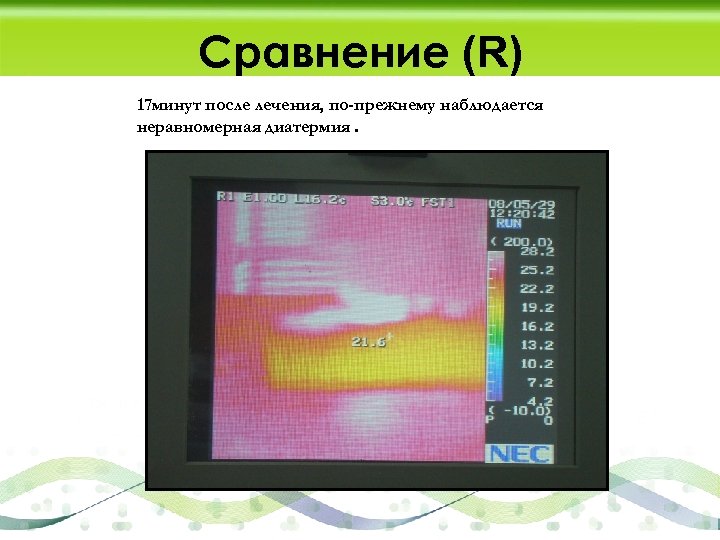 Сравнение (R) 17 минут после лечения, по-прежнему наблюдается неравномерная диатермия. 