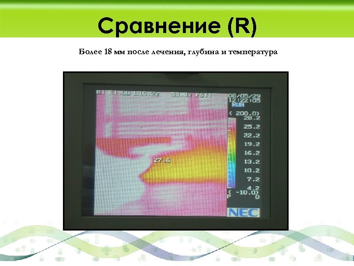Сравнение (R) Более 18 мм после лечения, глубина и температура 