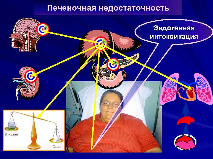 Печеночная недостаточность Эндогенная интоксикация 