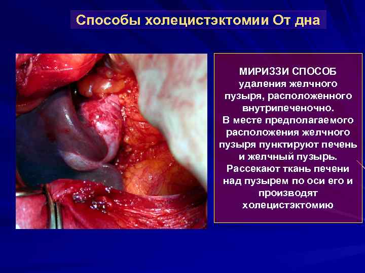 Способы холецистэктомии От дна МИРИЗЗИ СПОСОБ удаления желчного пузыря, расположенного внутрипеченочно. В месте предполагаемого