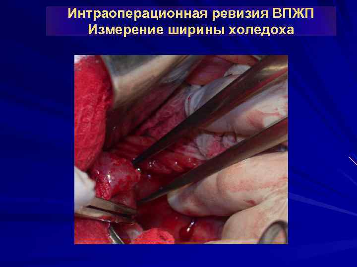 Интраоперационная ревизия ВПЖП Измерение ширины холедоха 