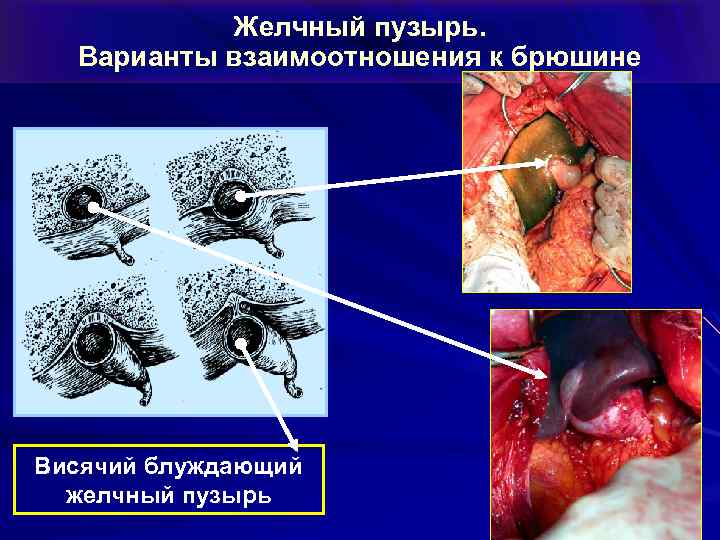 Желчный пузырь. Варианты взаимоотношения к брюшине Висячий блуждающий желчный пузырь 