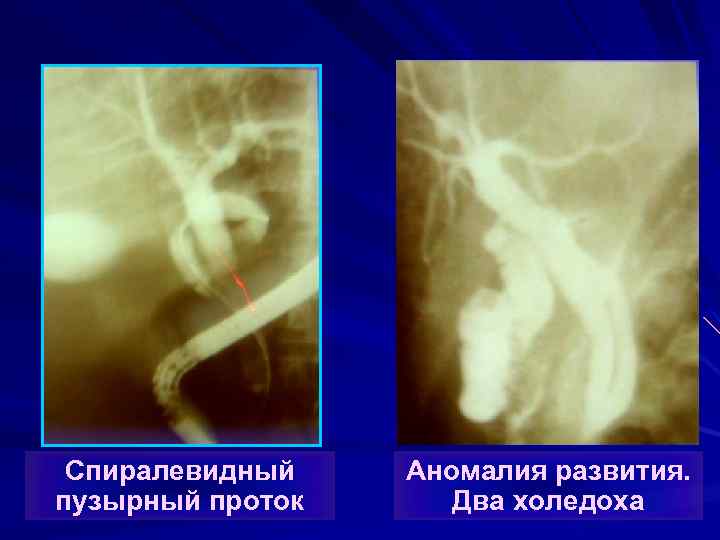 Спиралевидный пузырный проток Аномалия развития. Два холедоха 