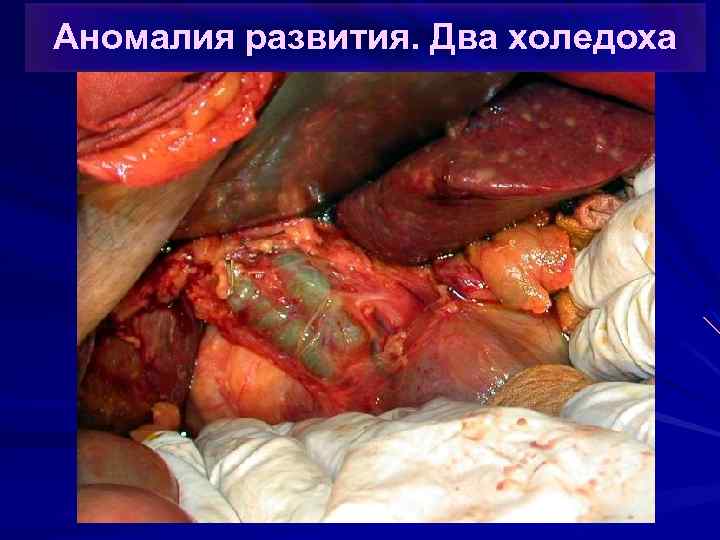 Аномалия развития. Два холедоха 