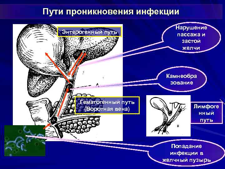 Пути проникновения инфекции Энтерогенный путь Нарушение пассажа и застой желчи Камнеобра зование Гематогенный путь