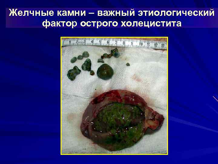 Желчные камни – важный этиологический фактор острого холецистита 